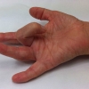 Лечение болезни Нотта ("щелкающий палец") - ortoped-nv.ru - Нижневартовск